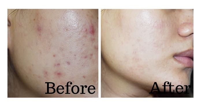 ミレム　ビュートリックの使用前使用後⑤